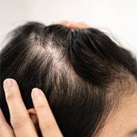 hair loss